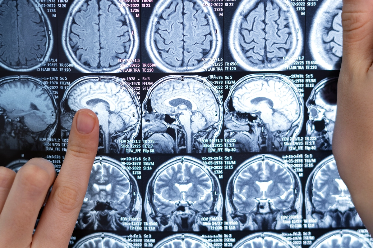 Diagnosing Alzheimer’s disease