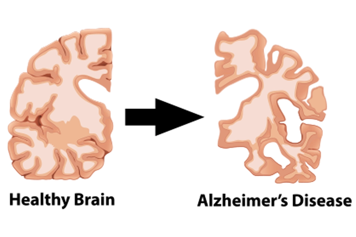 What is Alzheimer’s disease?